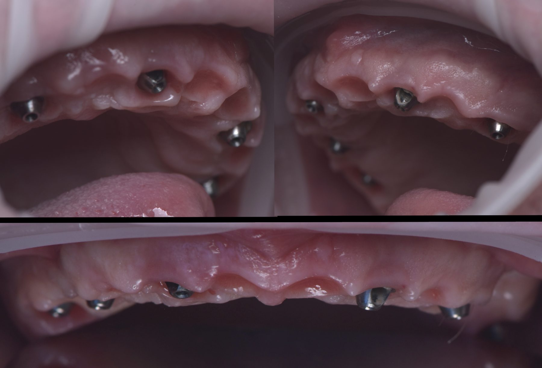 Encía cicatrizada alrededor de los implantes