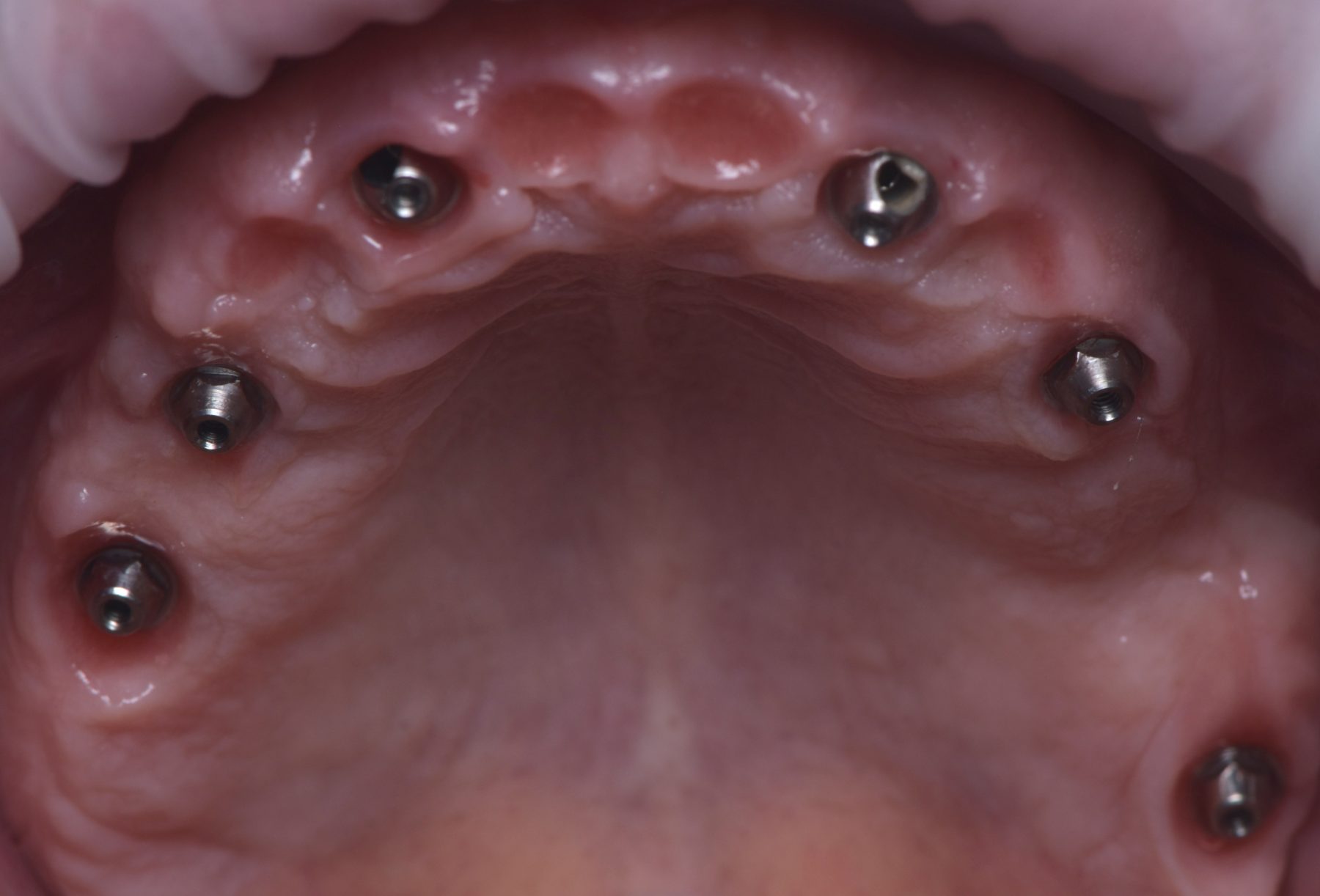 Vista oclusal de seis implantes con pilares en el maxilar