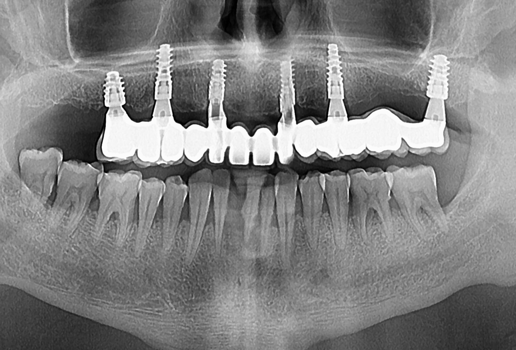 Radiografía panorámica con seis implantes y la prótesis definitiva