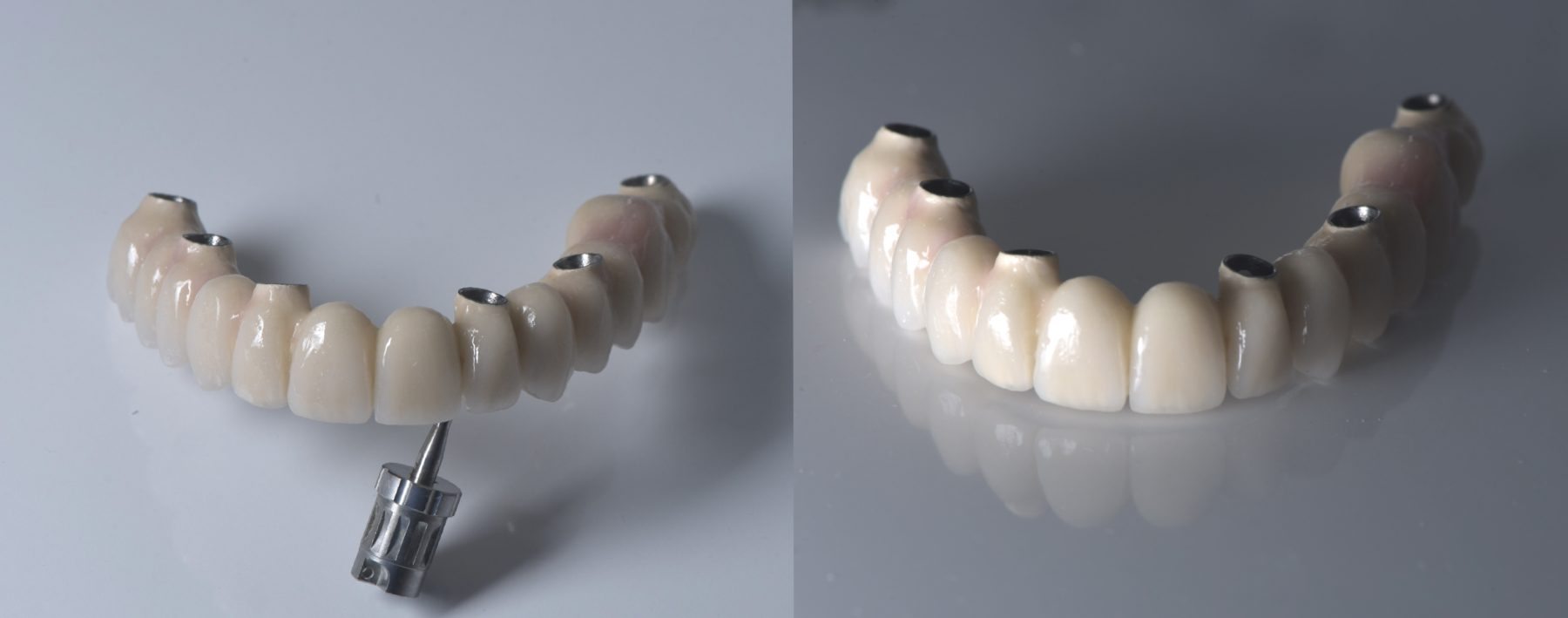 Prótesis definitiva de zirconia