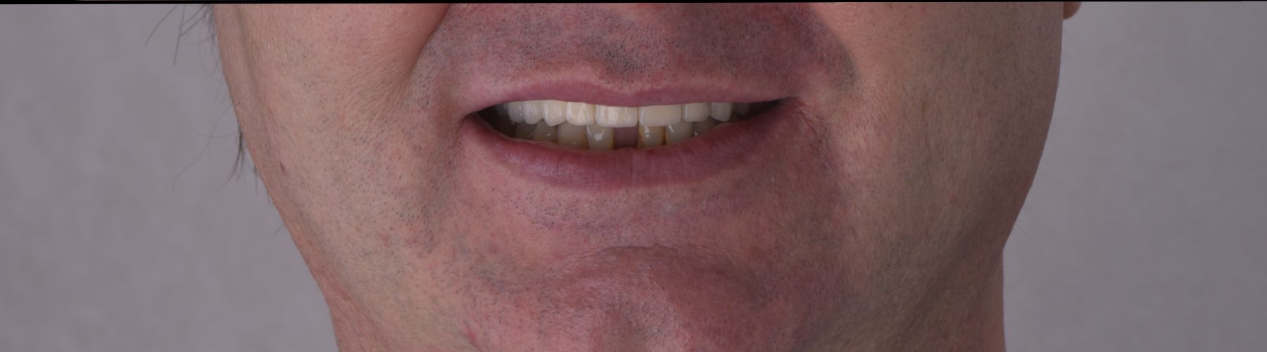 Sonrisa con dientes fijos sobre implantes